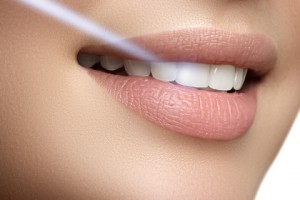 Perfect smile after bleaching. Dental care and whitening teeth. Laser teeth whitening